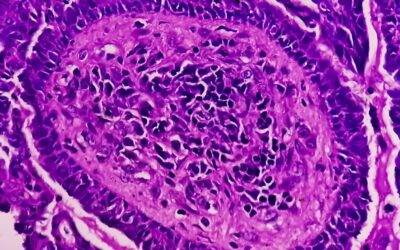 Evaluated Impact of Triptorelin Peptide in Endometriosis and Cancer Studies